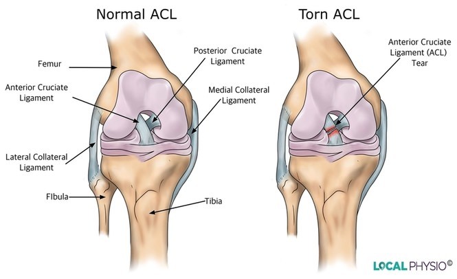 normal acl vs torn acl